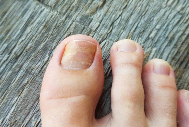 Toenail Fungus: A Common Problem with Effective Remedies